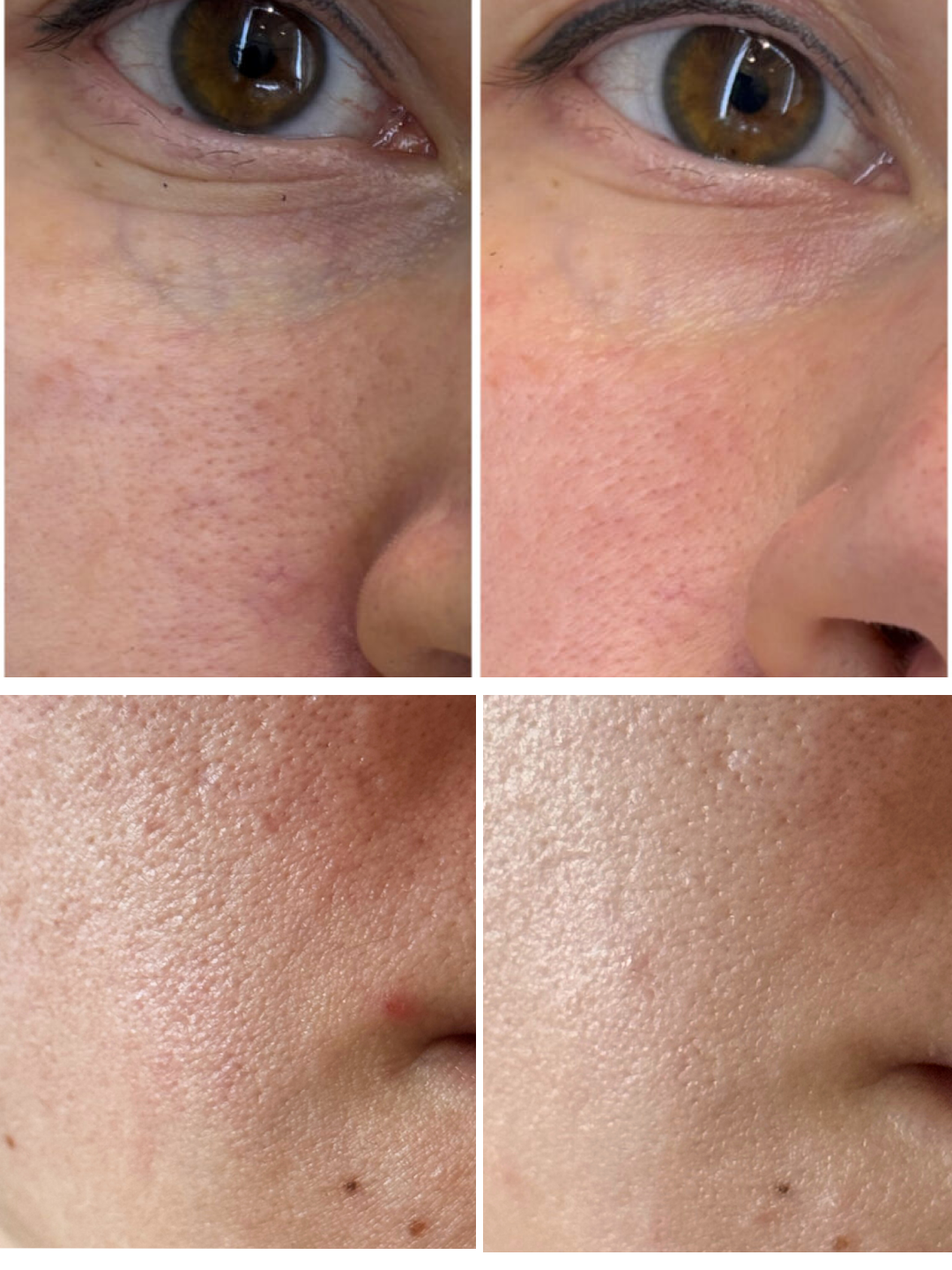 Сироватка для звуження пор Surgene Pores Corrector Serum